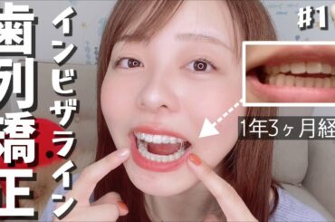 【費用明細公開】アラサーから歯列矯正スタート！他の矯正との違いや、メリット&デメリットは？